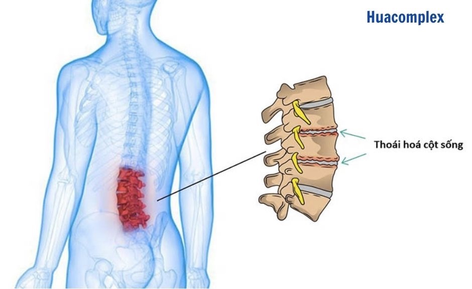 Thoái hoá cột sống thắt lưng Thoái hoá cột sống thắt lưng