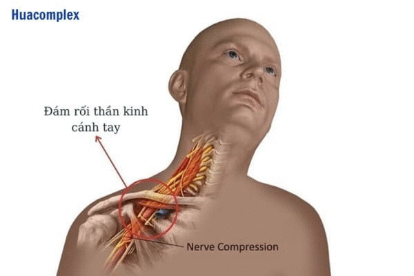 Hội chứng rễ thần kinh