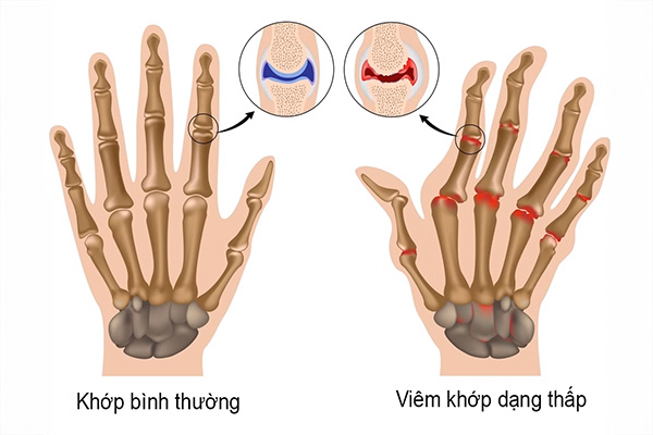 Bệnh lý phổ biến nhiều ở nữ so với nam, thường ở độ tuổi trung niên, đi kèm với các dấu hiệu lâm sàng, cận lâm sàng rõ ràng