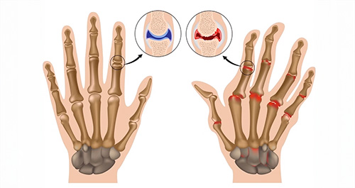 Viêm khớp dạng thấp
