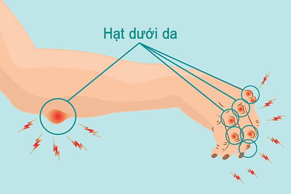 Tình trạng hạt dưới da hiếm gặp ở Việt Nam
