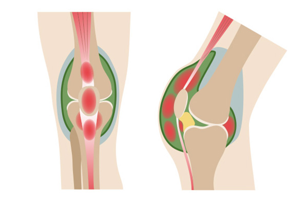 Viêm màng hoạt dịch khớp gối biểu hiện bởi tình trạng sưng đau một hay hai khớp gối kéo dài