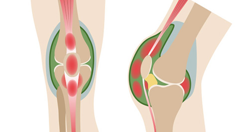 Viêm màng hoạt dịch khớp gối