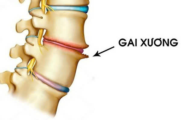 Gai xương thân đốt sống