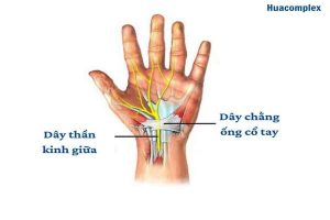 Hội chứng ống cổ tay là tình trạng chèn ép dây thần kinh giữa