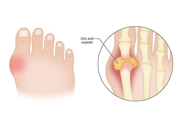 Tinh thể natri urat tập trung lại ở khớp và gây viêm, sưng và đau đớn cho bệnh nhân