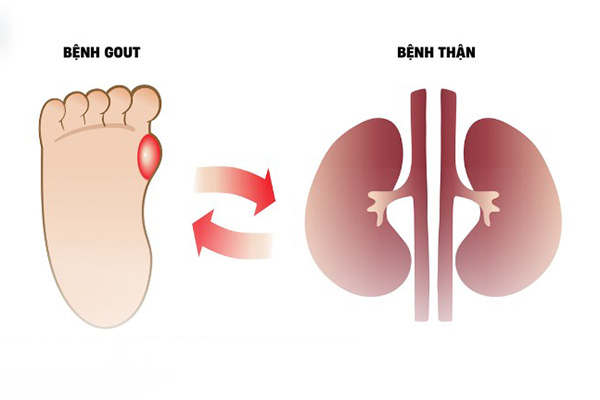 Bệnh gút và bệnh thận, đặc biệt là sỏi thận có mối liên hệ nhất định