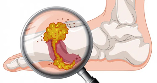Bệnh gút, nguyên nhân và điều trị bệnh