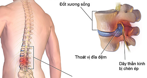 Thoát vị đĩa đệm