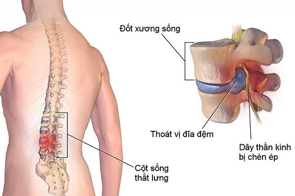 Thoát vị đĩa đệm là tình trạng nhân nhầy đĩa đệm cột sống thoát ra khỏi vị trí bình thường trong vòng sợi, chèn ép vào ống sống hay các rễ thần kinh sống