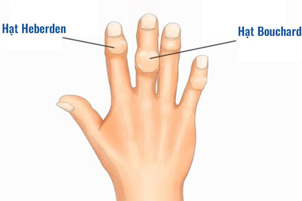 Tỷ lệ nữ mắc nhiều hơn nam, thoái hoá khớp ngón xa có hạt Heberden, khớp ngón gần hạt Bouchard Tỷ lệ nữ mắc nhiều hơn nam, thoái hoá khớp ngón xa có hạt Heberden, khớp ngón gần hạt Bouchard