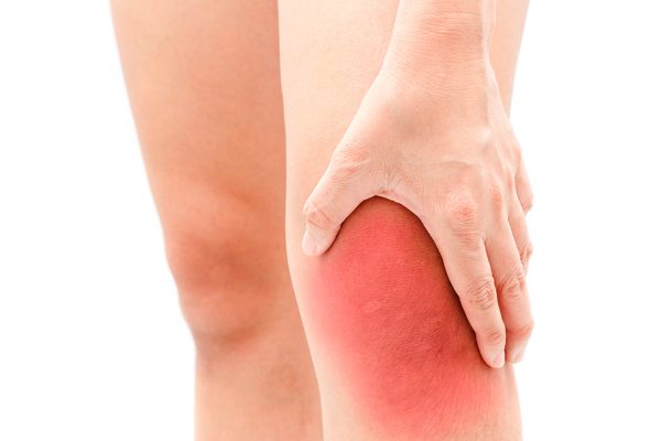 Đau sưng, tràn dịch ở khớp gối là biểu hiện của thoái hoá Đau sưng, tràn dịch ở khớp gối là biểu hiện của thoái hoá