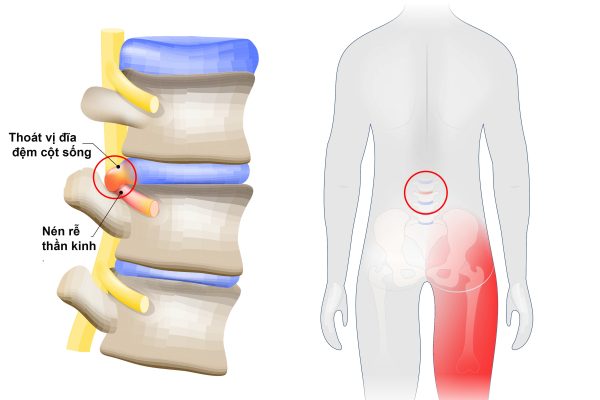 Triệu chứng đau lan từ cột sống thắt lưng xuống mông do thoát vị đĩa đệm