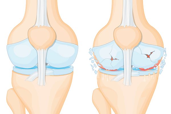 Khớp thoái hoá bị mất chất sụn, khô chất nhờn và thoái hóa dây chằng khớp Khớp thoái hoá bị mất chất sụn, khô chất nhờn và thoái hóa dây chằng khớp