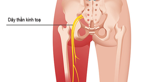Đau dây thần kinh toạ là cảm giác đau dọc theo đường đi của thần kinh toạ