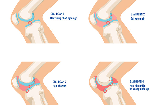Các giai đoạn của thoái hoá khớp