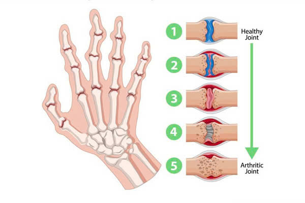 Khi sụn khớp bị bào mòn, các đầu xương cọ xát vào nhau, dẫn đến phản ứng viêm, hình thành gai xương và gây sưng tấy vùng khớp.
